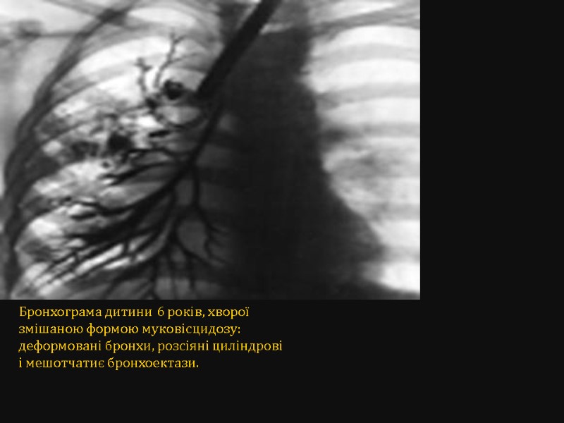 Бронхограма дитини 6 років, хворої змішаною формою муковісцидозу: деформовані бронхи, розсіяні циліндрові і мешотчатиє